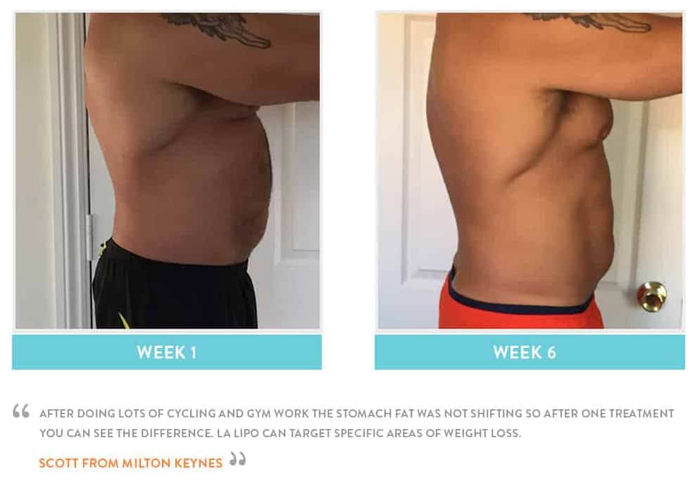 Before & After Stomach Fat Greater London (Redbridge)