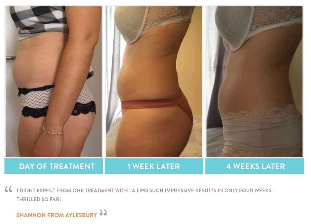 before, Cryolipolysis Greater London (Redbridge)
