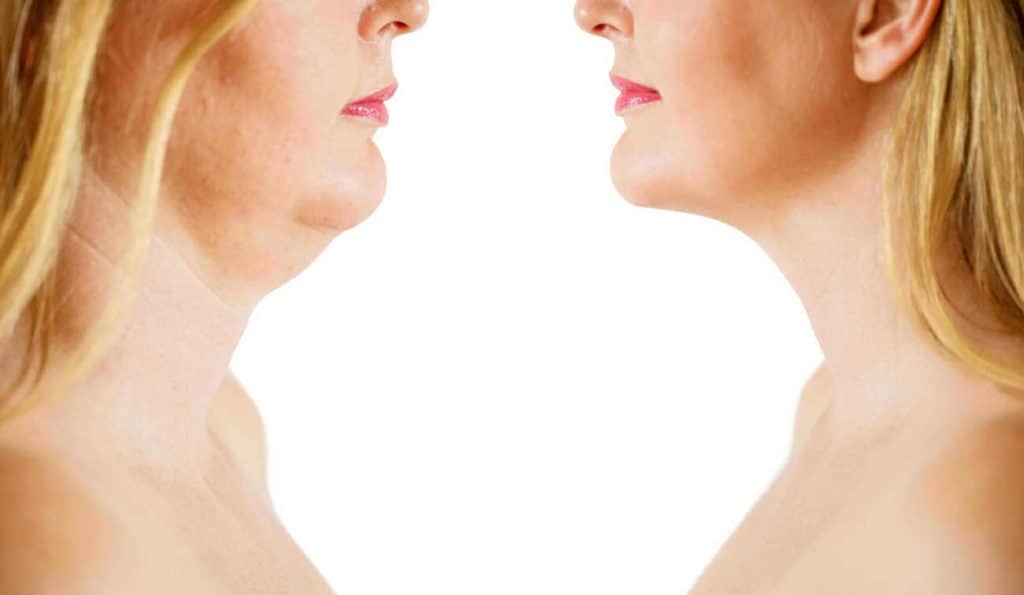 Double Chin treatment Greater London (Redbridge) before and after results