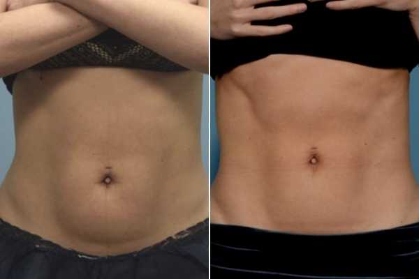 body sculpting FAQs Greater London (Redbridge)