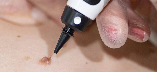 After Skin Tag Removal Greater London (Redbridge)