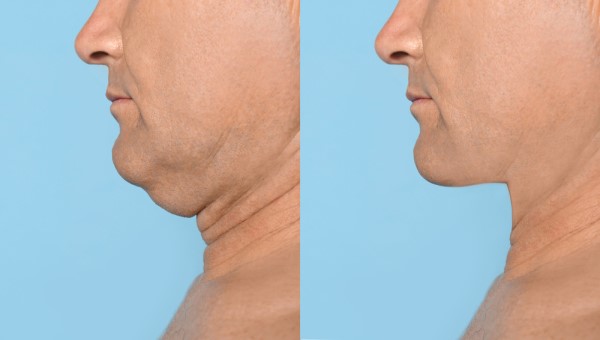 Which Non-Surgical Treatments Work Best for Jowls and Loose Skin Greater London (Redbridge)?