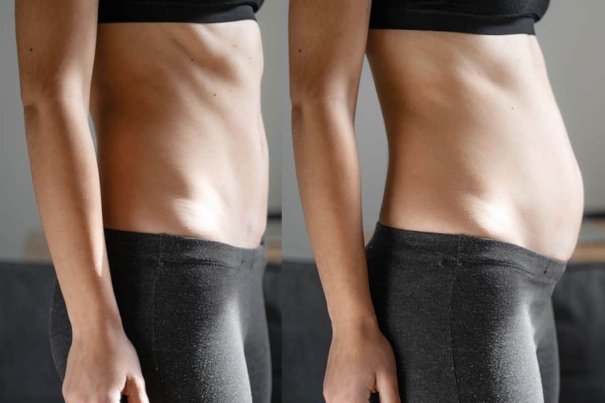 How long does diastasis recti take to improve Greater London (Redbridge)?