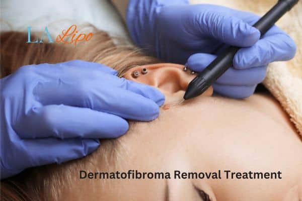 Dermatofibroma Removal Treatment Greater London (Redbridge)