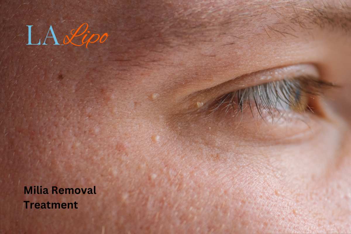 Cryopen Milia Removal: Is It the Easiest and Safest Option Greater London (Redbridge)?