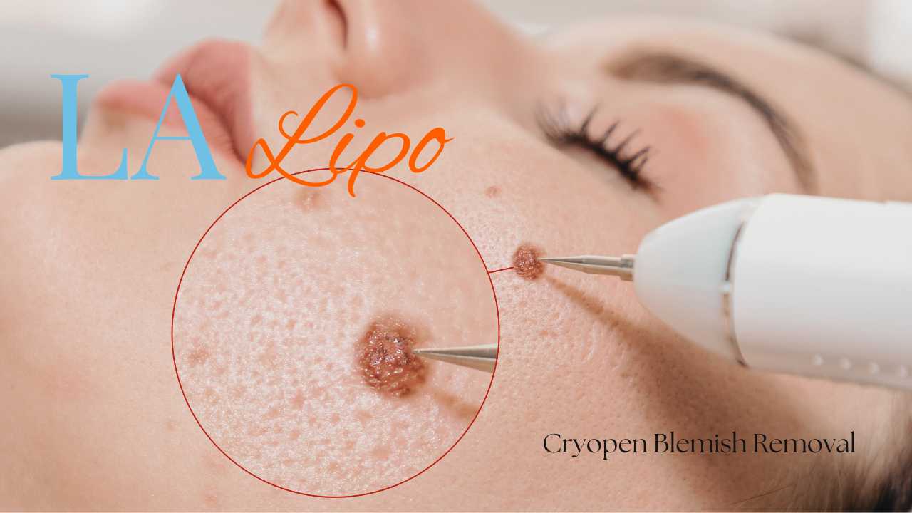 cryopen blemish removal Greater London (Redbridge) Contact our team today!