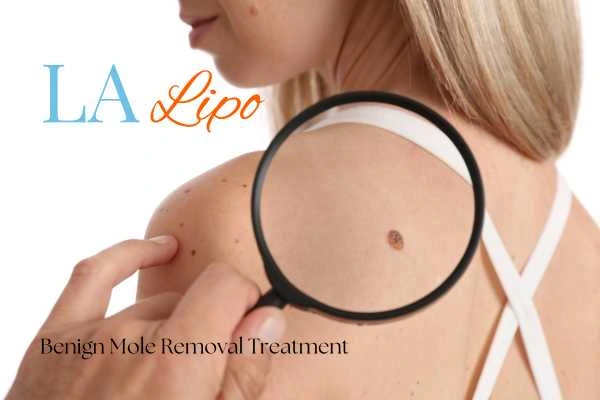 Why getting moles removed Greater London (Redbridge) can boost your confidence!