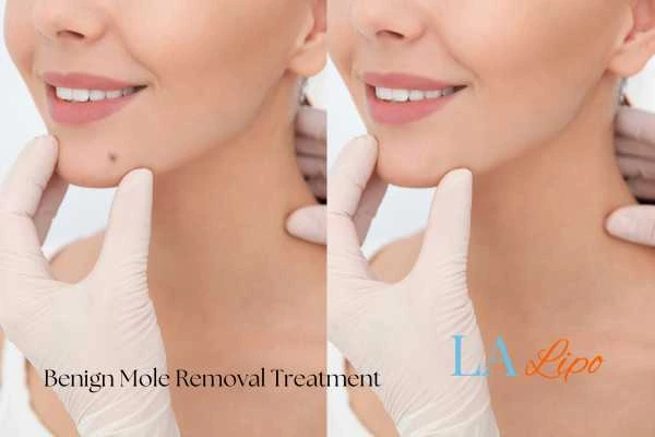 Woman's before and after results of being moles removal treatment Greater London (Redbridge)