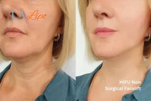 hi-fu for wrinkles Greater London (Redbridge) before and after results