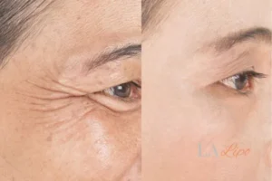 Before and after results of woman - HI-fu wrinkles reduction treatment Greater London (Redbridge)