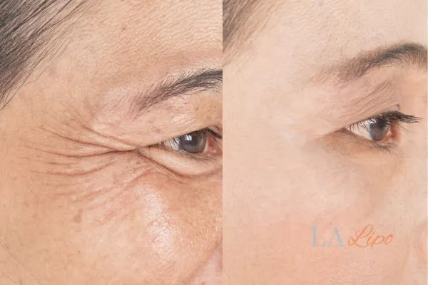 Before and after results of woman - HI-fu wrinkles reduction treatment Greater London (Redbridge)