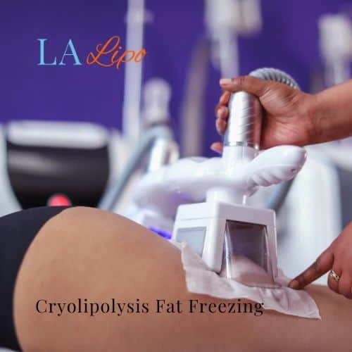 fat freezing - Cryolipolysis Greater London (Redbridge)