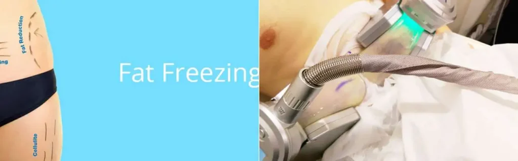 Fat freezing Greater London (Redbridge) on multiple areas of the body