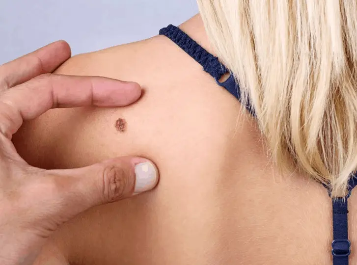 woman having mole removal Greater London (Redbridge) consultation before treatment.