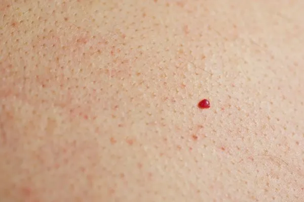 close up of a cherry angioma Greater London (Redbridge)
