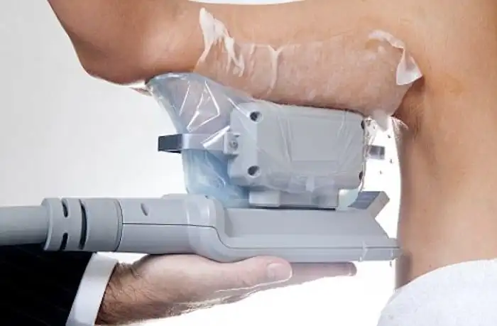 Picture of fat freezing Greater London (Redbridge) on the upper arms.