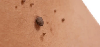 image of a skin tag Greater London (Redbridge)