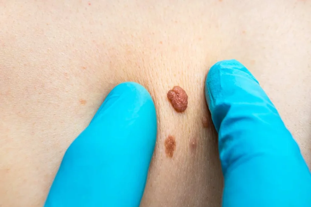 Consultant examining a skin tag Greater London (Redbridge)