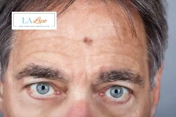 Solar Lentigo Removal Greater London (Redbridge) image of man with mark on his forehead
