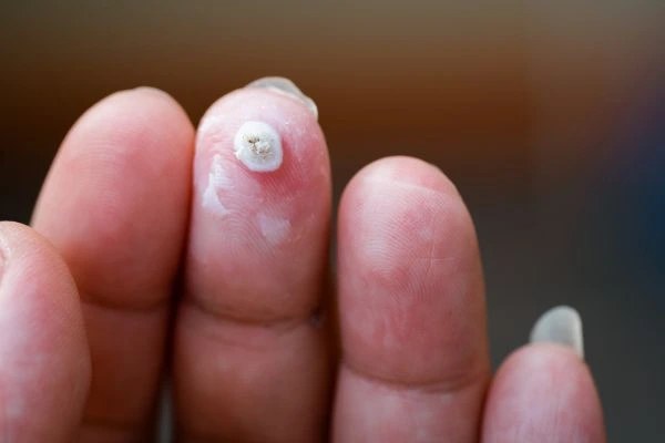 wart on person finger - cryotherapy to treat from LA LIPO Greater London (Redbridge)