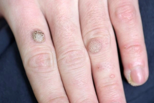 photo of warts on person hand - see wart removal Greater London (Redbridge) from LA LIPO