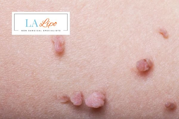 Does cryopen skin tag removal Greater London (Redbridge) hurt? Find out now call our team today!