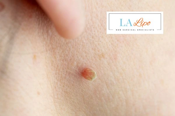 Book skin tag removal Greater London (Redbridge) today speak to our team now!