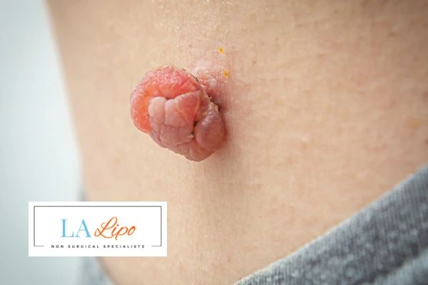 Interested in skin tag removal Greater London (Redbridge)? Concerned about the pain? Find out more today!