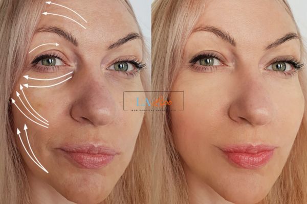 Morpheus 8 results Greater London (Redbridge) face lift.