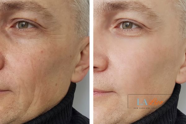 See the amazing results of Morpheus8 Treatment Greater London (Redbridge)!