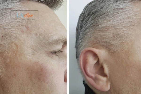 Mens Before & After Morpheus 8 Results Greater London (Redbridge)