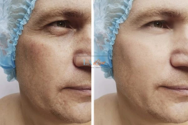 Before and after Morpheus 8 Results Greater London (Redbridge)