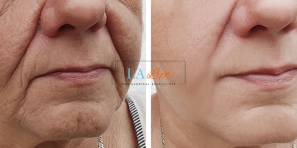 Older lady deeper wrinkle reduction - LA LIPO Morpheus 8 Results Greater London (Redbridge)
