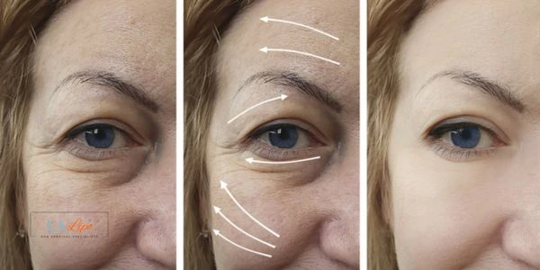 Amazing eye lift Morpheus 8 results Greater London (Redbridge)