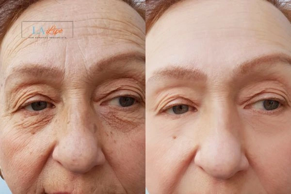 The powerful benefits of Morpheus8 Treatment Greater London (Redbridge) - Call Our team today!