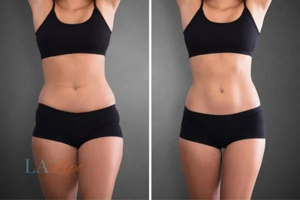 before and after results of non-surgical treatment to help a woman's body image and mental health Greater London (Redbridge)