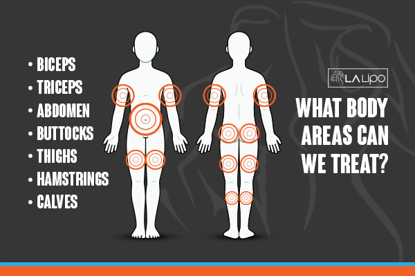 Diagram to show areas you can have LA-EMS Body Sculpting Treatment Greater London (Redbridge)