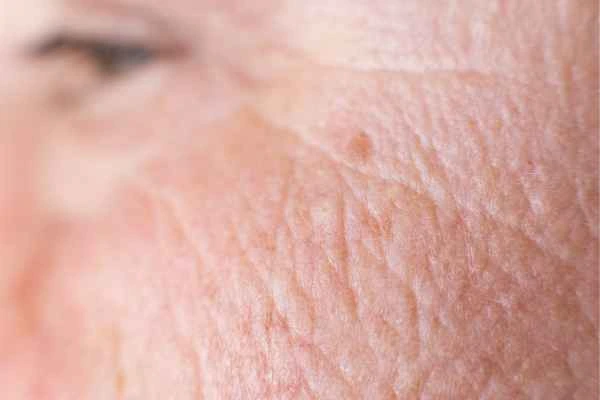 close up picture of a woman's face showing an age spot Greater London (Redbridge)