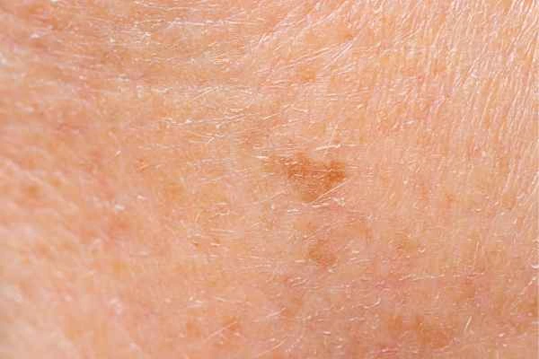 close up picture of age spots Greater London (Redbridge)
