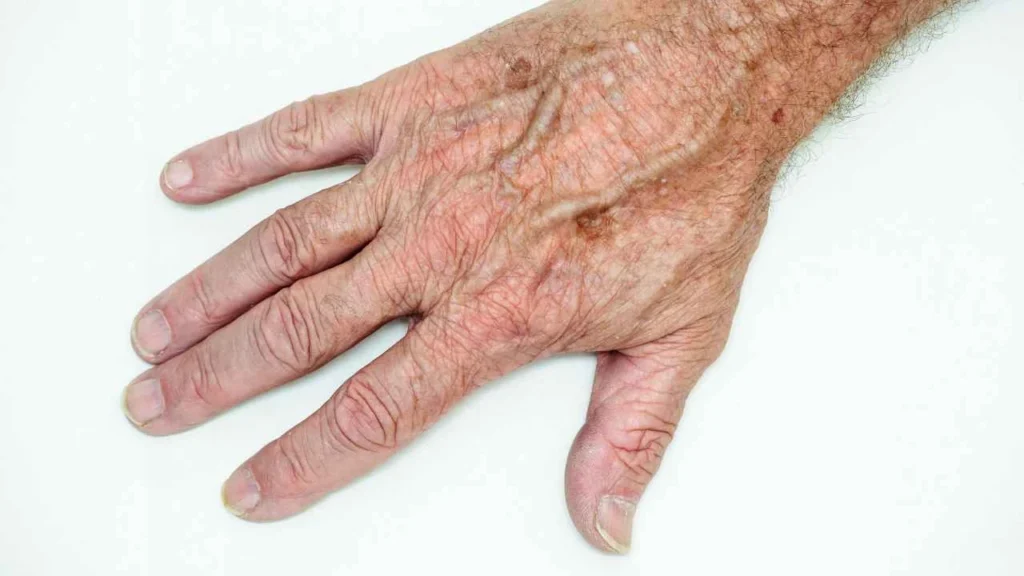 Male hand showing age spot Greater London (Redbridge)