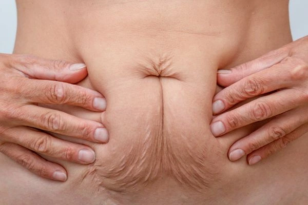 Image of a woman's stomach with loose skin - example of skin tightening Greater London (Redbridge) options